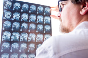 What to Expect at a Neurological Exam