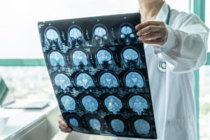 Factors that Can Affect Your Recovery from a Traumatic Brain Injury