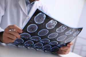 How Long Does It Take to Recover from a Mild Traumatic Brain Injury?