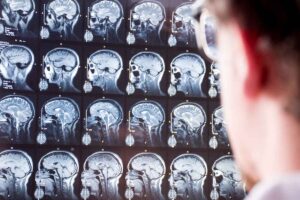 The Different Types and Classifications of Traumatic Brain Injuries